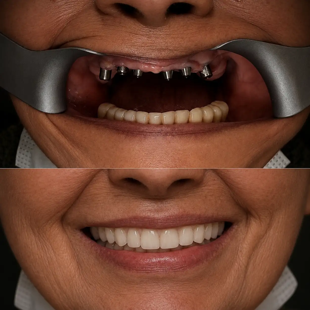 Antes e depois prótese protocolo