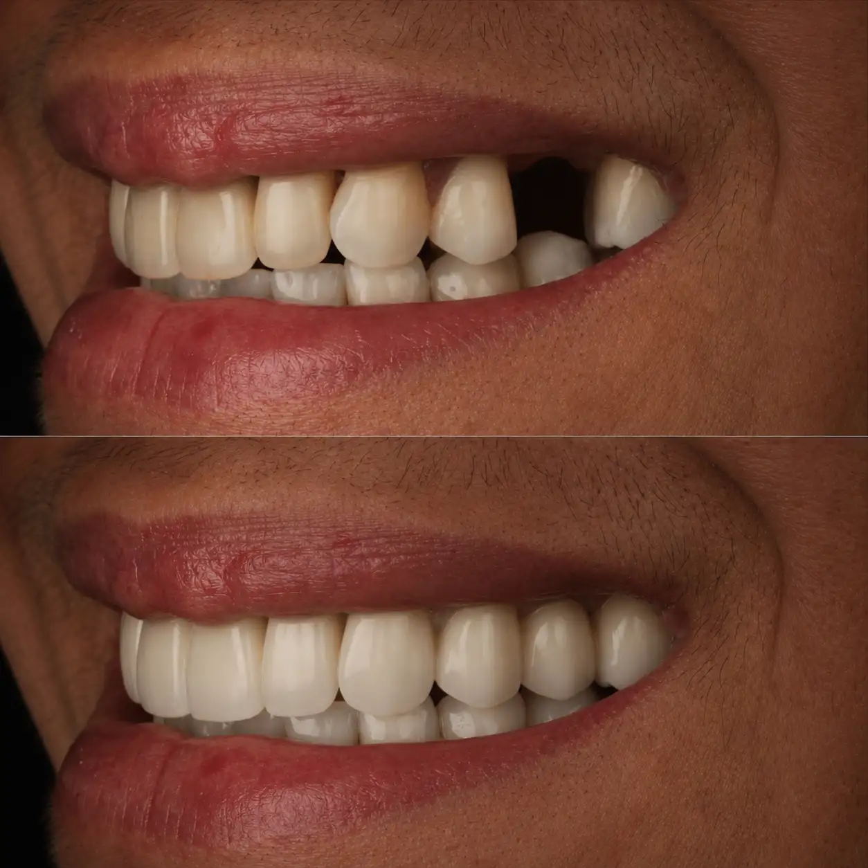 Implante anterior