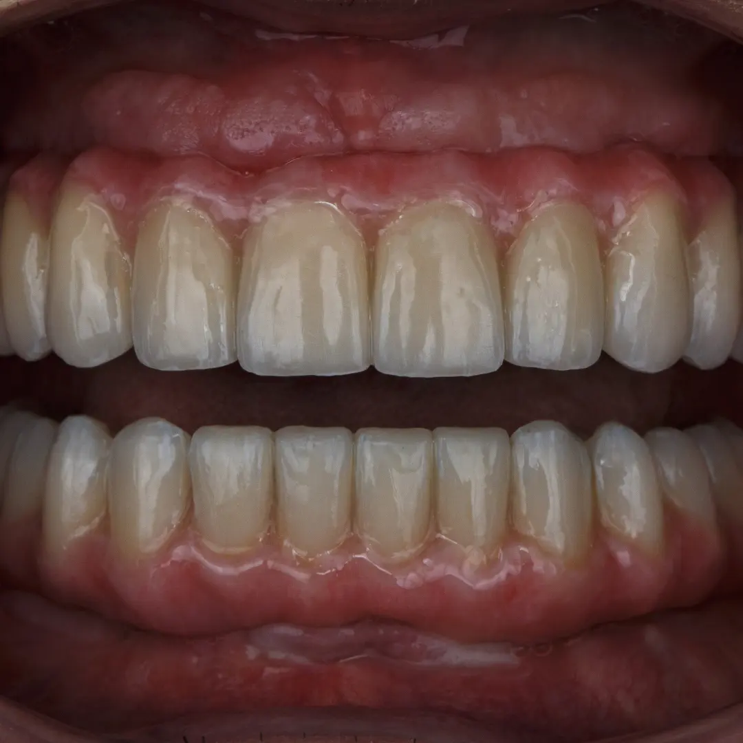 Antes e depois lateral