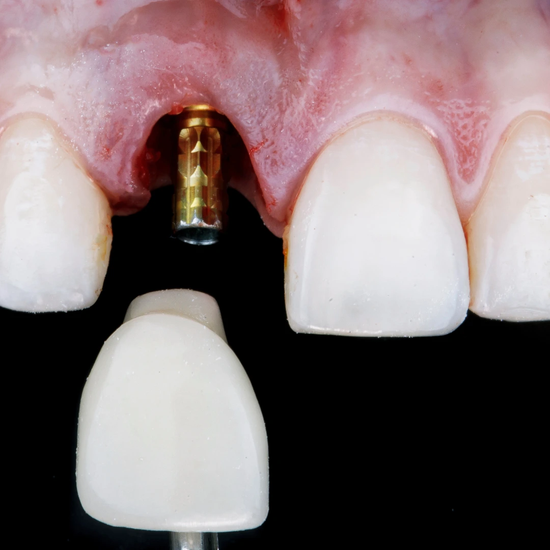 Antes e depois com implantes