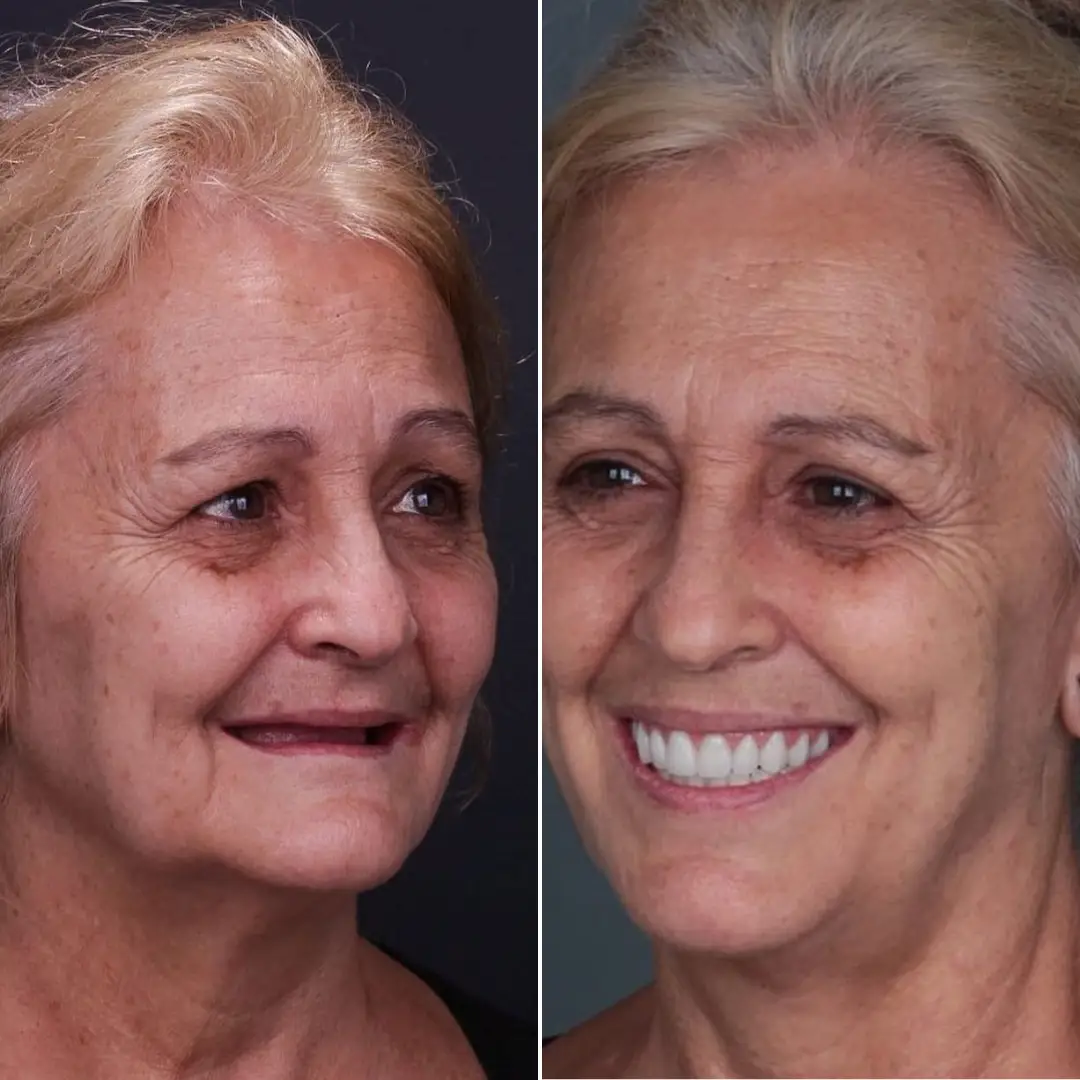 Antes e depois reabilitação
