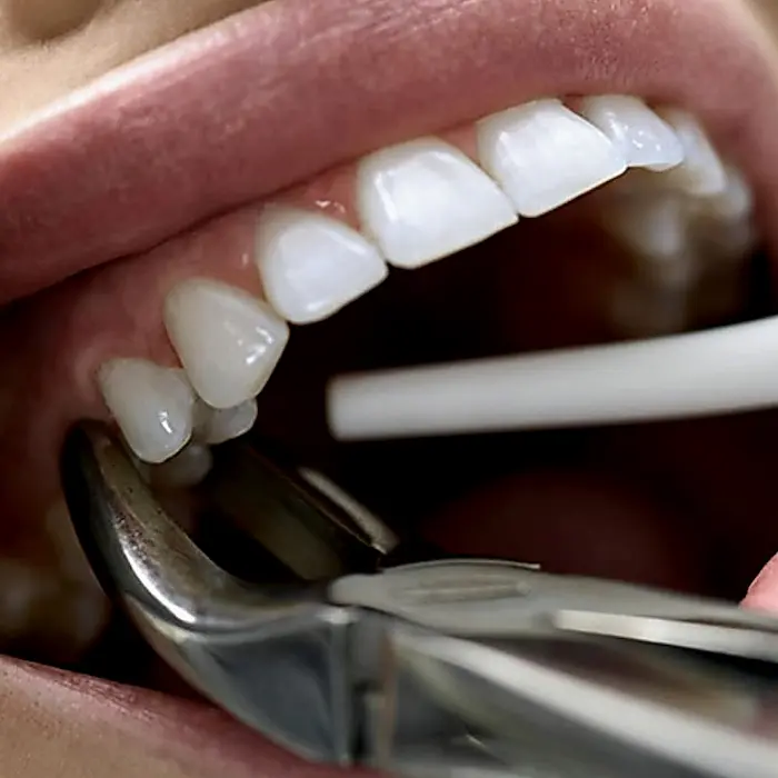 Extração de dente