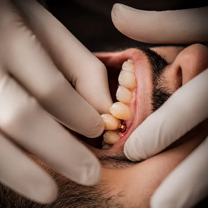 Implantes dentários